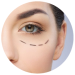 bleforoplastia