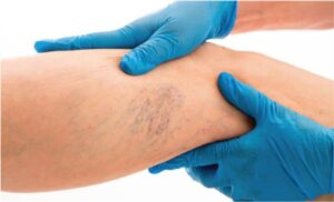 varices arañas