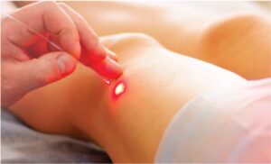 tratamiento con laser